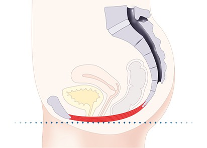 Pelvic-Floor Muscle Repair 7 Pelvic-Floor Muscle Repair