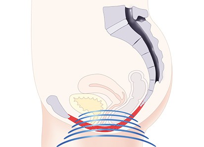 Pelvic-Floor Muscle Repair 6 Pelvic-Floor Muscle Repair