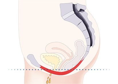 Pelvic-Floor Muscle Repair 5 Pelvic floor muscles Stroud